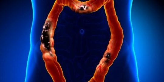 karkinos-paxeos-enterou-540×280