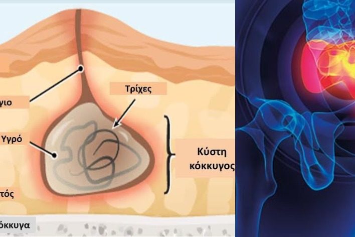 kysti kokkygos | Iatromedia.gr