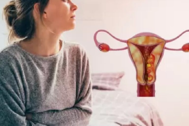 Ενδομητρίωση και καρκίνος