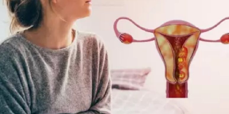 Ενδομητρίωση και καρκίνος Ενδομητρίωση και καρκίνος