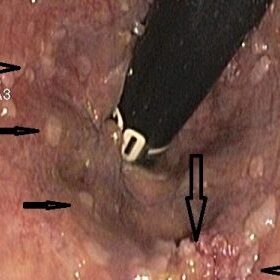 APC – Διαθερμοπηξία με argon plasma coagulation!