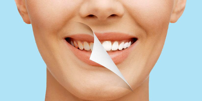 Οι 3 τρόποι λεύκανσης δοντιών για ένα μοναδικό χαμόγελο!