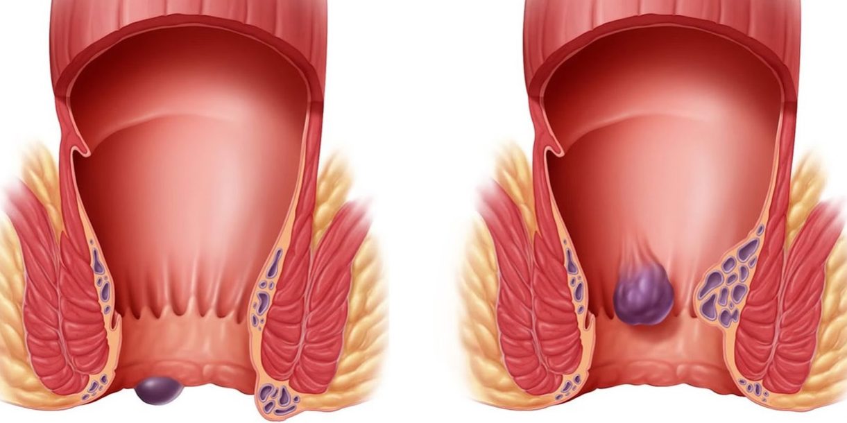 Γιατί έχετε αιμορροΐδες και τι μπορείτε να κάνετε