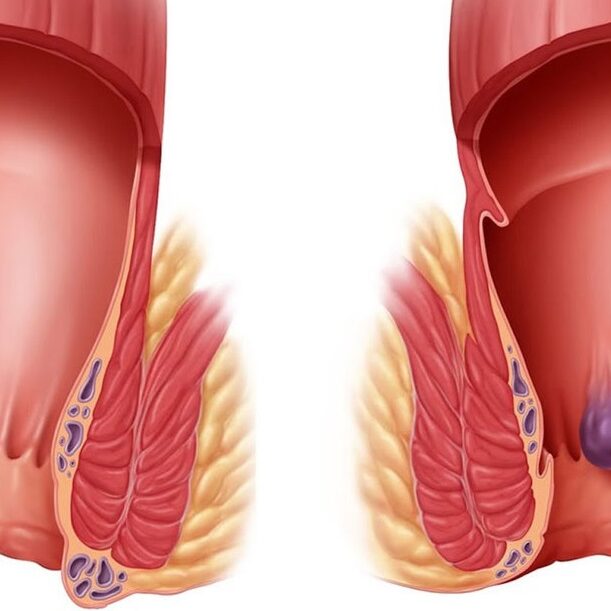 Γιατί έχετε αιμορροΐδες και τι μπορείτε να κάνετε