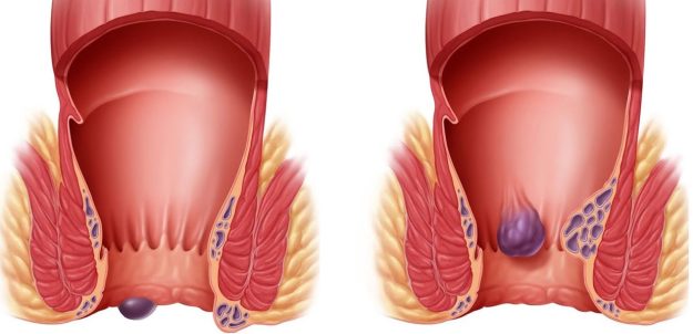 Γιατί έχετε αιμορροΐδες και τι μπορείτε να κάνετε
