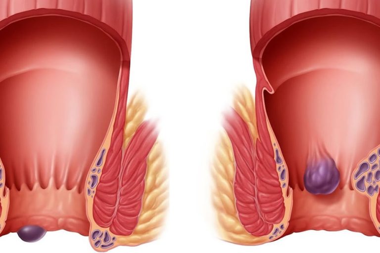 Γιατί έχετε αιμορροΐδες και τι μπορείτε να κάνετε