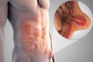 Λαπαροσκοπική Αποκατάσταση Βουβωνοκήλης