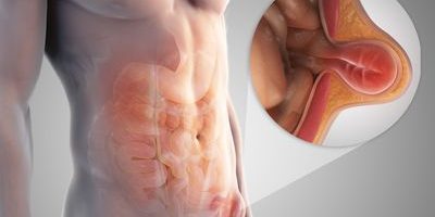 Λαπαροσκοπική Αποκατάσταση Βουβωνοκήλης