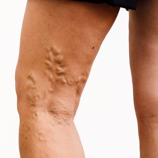 Αντιμετώπιση Κιρσών: Είναι Όλα Τα Laser Ίδια;