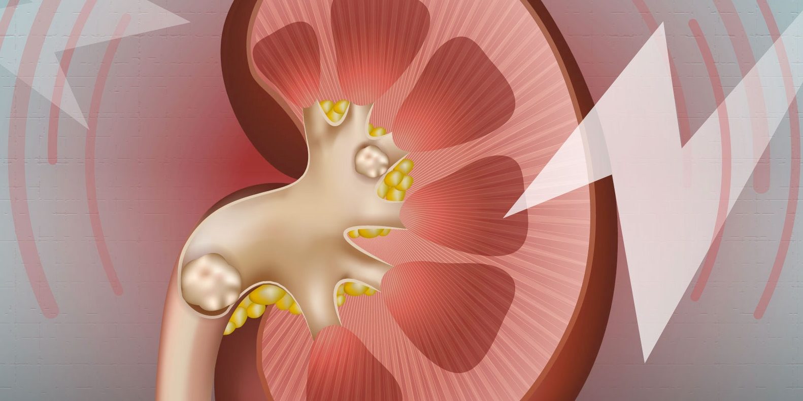 Μελέτη που ανατρέπει όσα ξέρουμε για τις πέτρες στα νεφρά