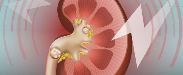 Μελέτη που ανατρέπει όσα ξέρουμε για τις πέτρες στα νεφρά