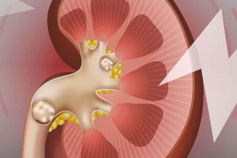 Μελέτη που ανατρέπει όσα ξέρουμε για τις πέτρες στα νεφρά