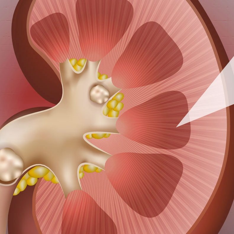 Μελέτη που ανατρέπει όσα ξέρουμε για τις πέτρες στα νεφρά