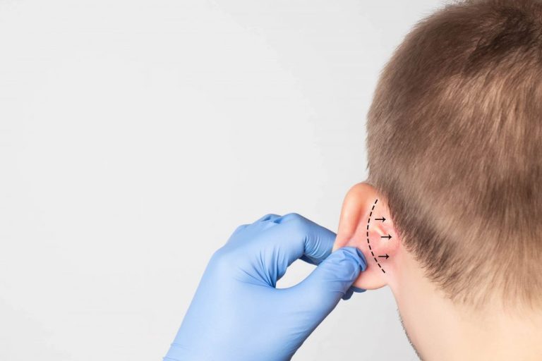 Πλαστική αυτιών Πλαστική αυτιών