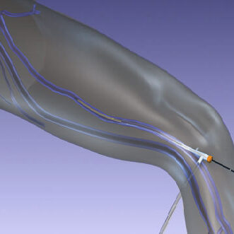 Συχνές Ερωτήσεις Ασθενών Σχετικά Με Τους Κιρσούς Κάτω Άκρων