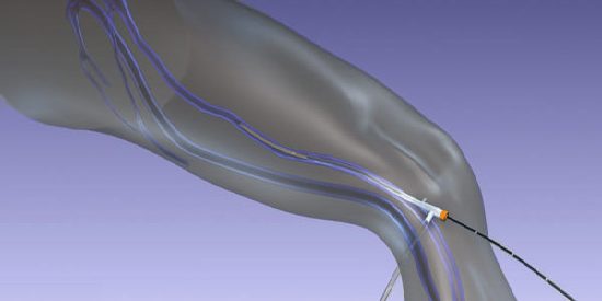 Συχνές Ερωτήσεις Ασθενών Σχετικά Με Τους Κιρσούς Κάτω Άκρων Συχνές Ερωτήσεις Ασθενών Σχετικά Με Τους Κιρσούς Κάτω Άκρων