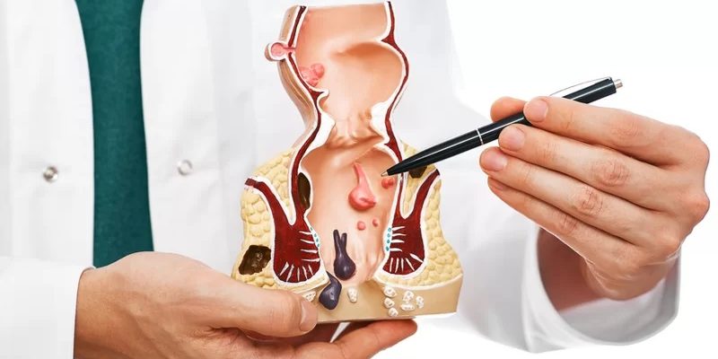 Άλγος (ή και αίμα) στον Πρωκτό: Δεν οφείλεται πάντα σε αιμορροΐδες!