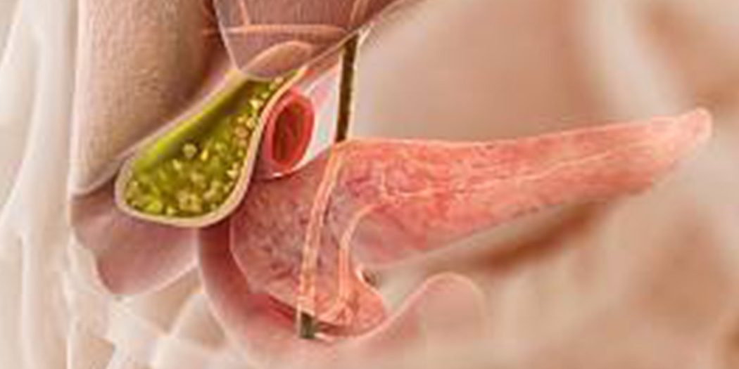 Όλα όσα χρειάζεται να γνωρίζετε για τους χολόλιθους