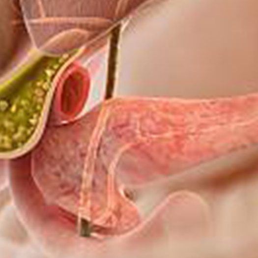 Όλα όσα χρειάζεται να γνωρίζετε για τους χολόλιθους