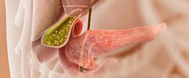 Όλα όσα χρειάζεται να γνωρίζετε για τους χολόλιθους