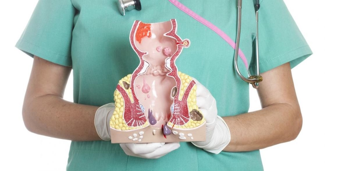 Όσα πρέπει να γνωρίζετε για την πρόπτωση του ορθού