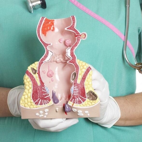 Όσα πρέπει να γνωρίζετε για την πρόπτωση του ορθού