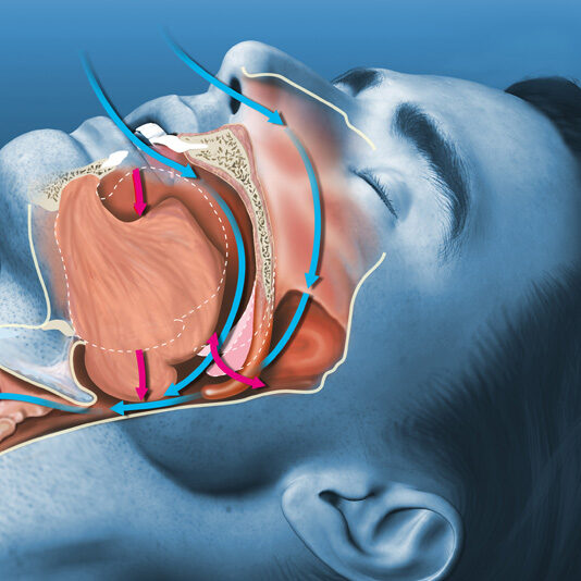 ΑΠΟΦΡΑΚΤΙΚΗ ΥΠΝΙΚΗ ΑΠΝΟΙΑ – ΡΟΧΑΛΗΤΟ – ΘΕΡΑΠΕΙΑ