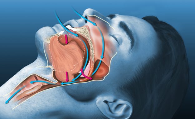 ΑΠΟΦΡΑΚΤΙΚΗ ΥΠΝΙΚΗ ΑΠΝΟΙΑ – ΡΟΧΑΛΗΤΟ – ΘΕΡΑΠΕΙΑ