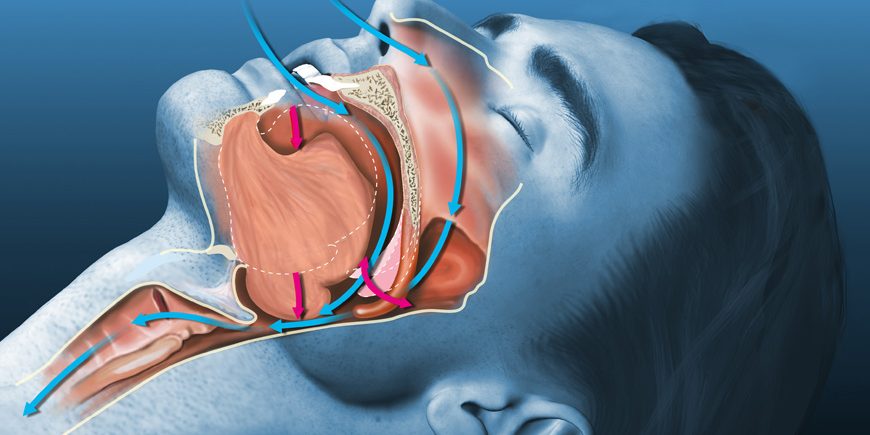 ΑΠΟΦΡΑΚΤΙΚΗ ΥΠΝΙΚΗ ΑΠΝΟΙΑ – ΡΟΧΑΛΗΤΟ – ΘΕΡΑΠΕΙΑ