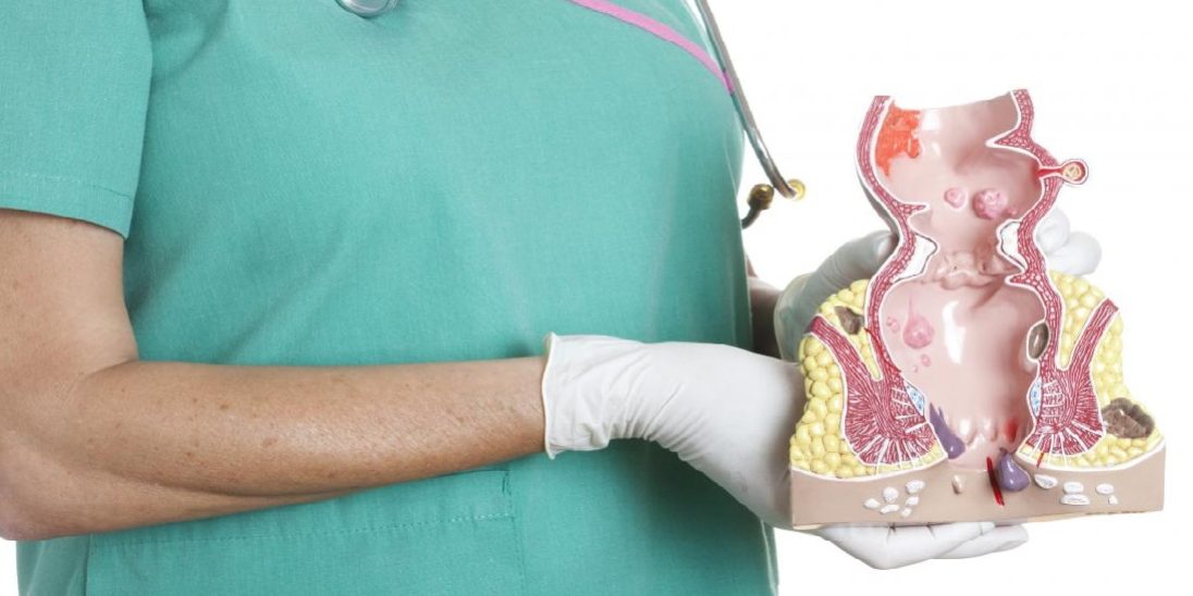 Αιμορροΐδες, αλκοόλ και καπνός. Υπάρχει σχέση μεταξύ τους;