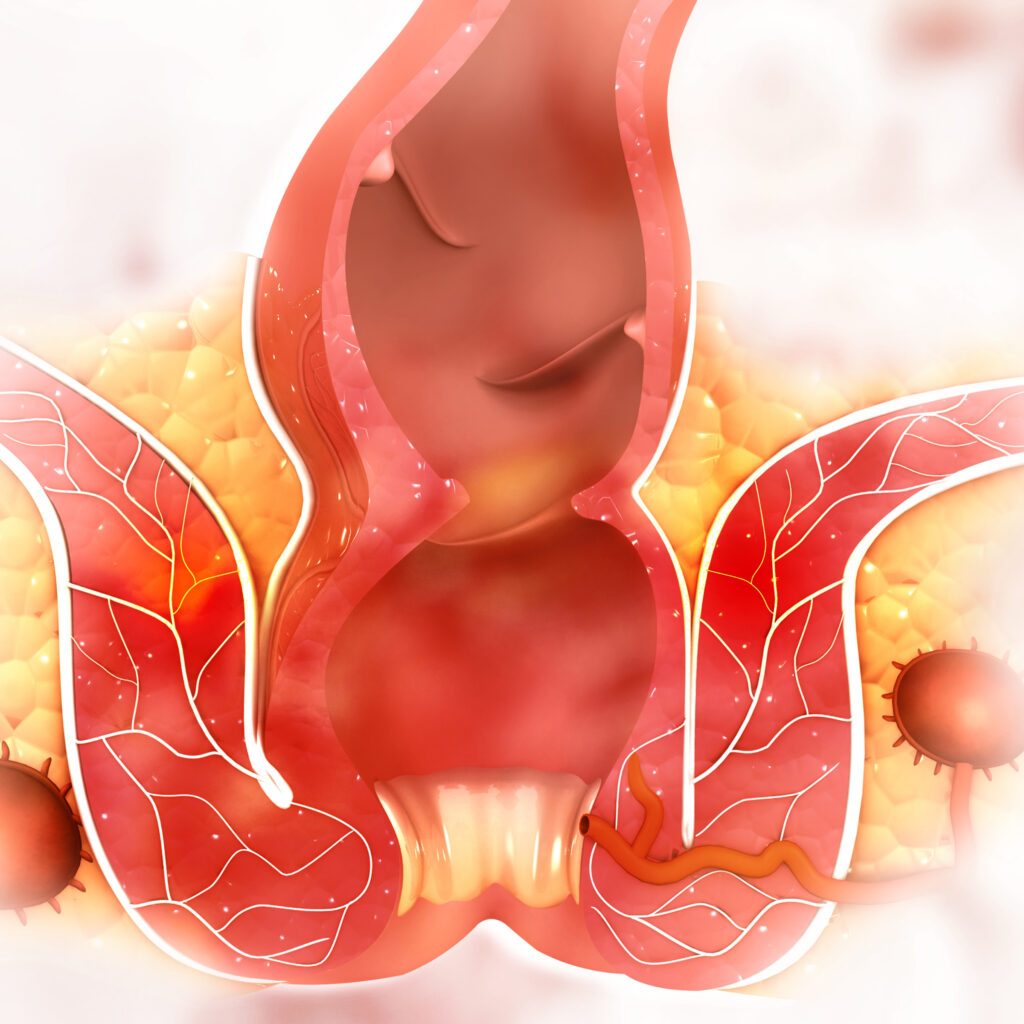 Αιμορροΐδες κατά τη διάρκεια της εγκυμοσύνης