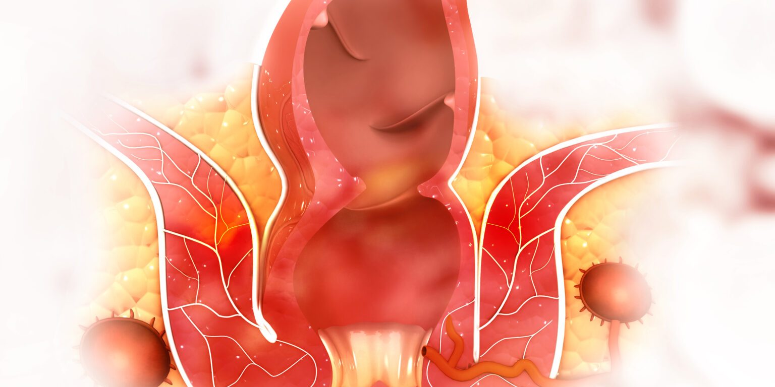 Αιμορροΐδες κατά τη διάρκεια της εγκυμοσύνης