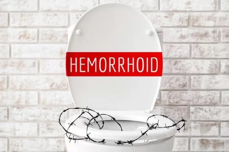 Αιμορροΐδες – Tips που απαλύνουν τον πόνο από την πρώτη μέρα εμφάνισής τους
