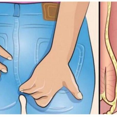 Αλοιφές για Αιμορροίδες και Φαρμακευτική Αγωγή