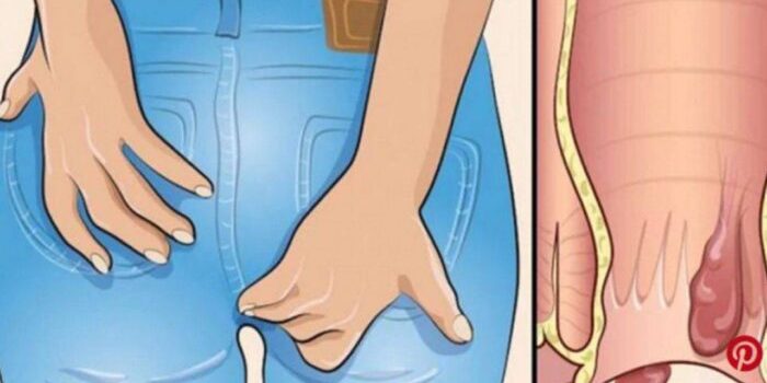 Αλοιφές για Αιμορροίδες και Φαρμακευτική Αγωγή