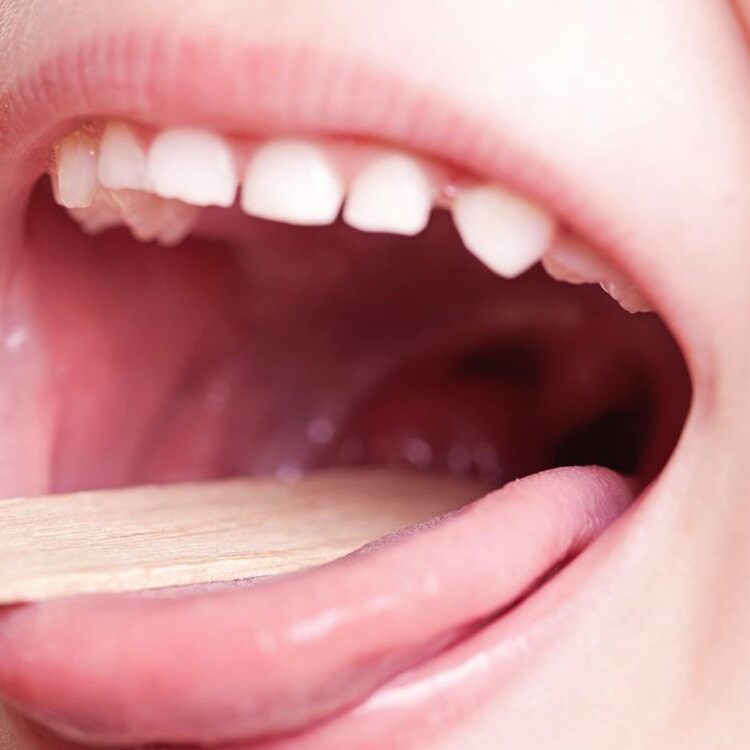 Αμυγδαλίτιδα: Αίτια, συμπτώματα & θεραπεία