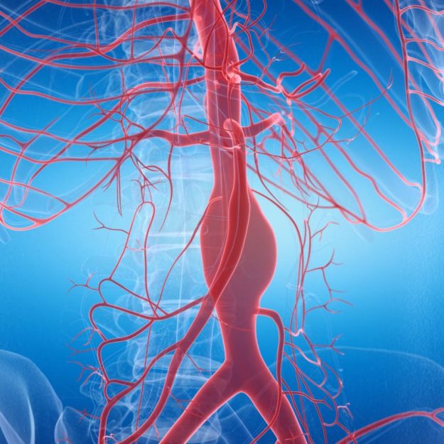 Ανεύρυσμα κοιλιακής αορτής και συμπτώματα: Πώς εκδηλώνεται & πώς αντιμετωπίζεται