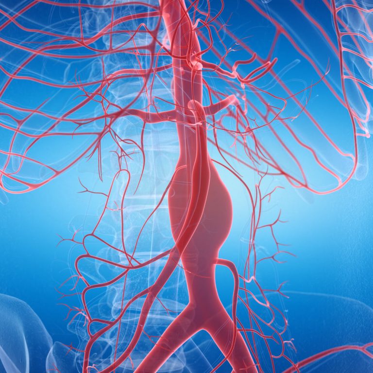 Ανεύρυσμα κοιλιακής αορτής και συμπτώματα: Πώς εκδηλώνεται & πώς αντιμετωπίζεται