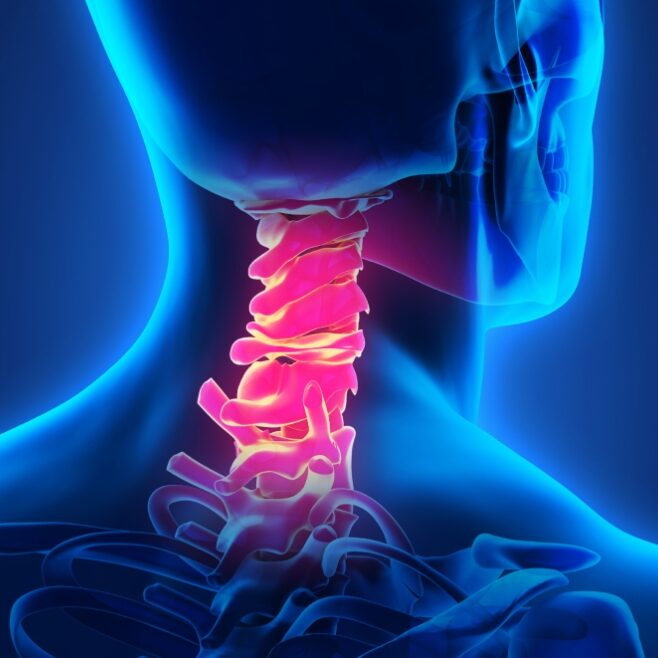 Αντικατάσταση Αυχενικού Δίσκου και Οφέλη