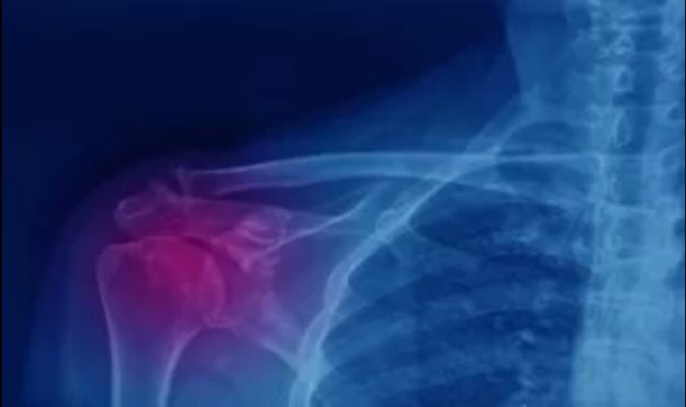 Ασβέστωμα στον Ώμο