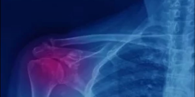 Ασβέστωμα στον Ώμο Ασβέστωμα στον Ώμο