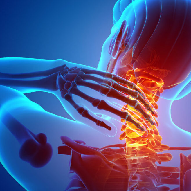 Αρθρίτιδα Αυχένα