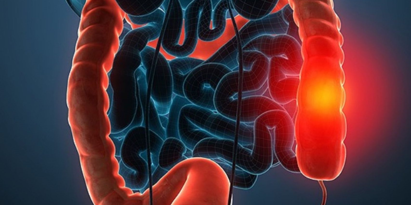 Βιοψία του ορθού