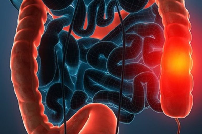 Βιοψία του ορθού