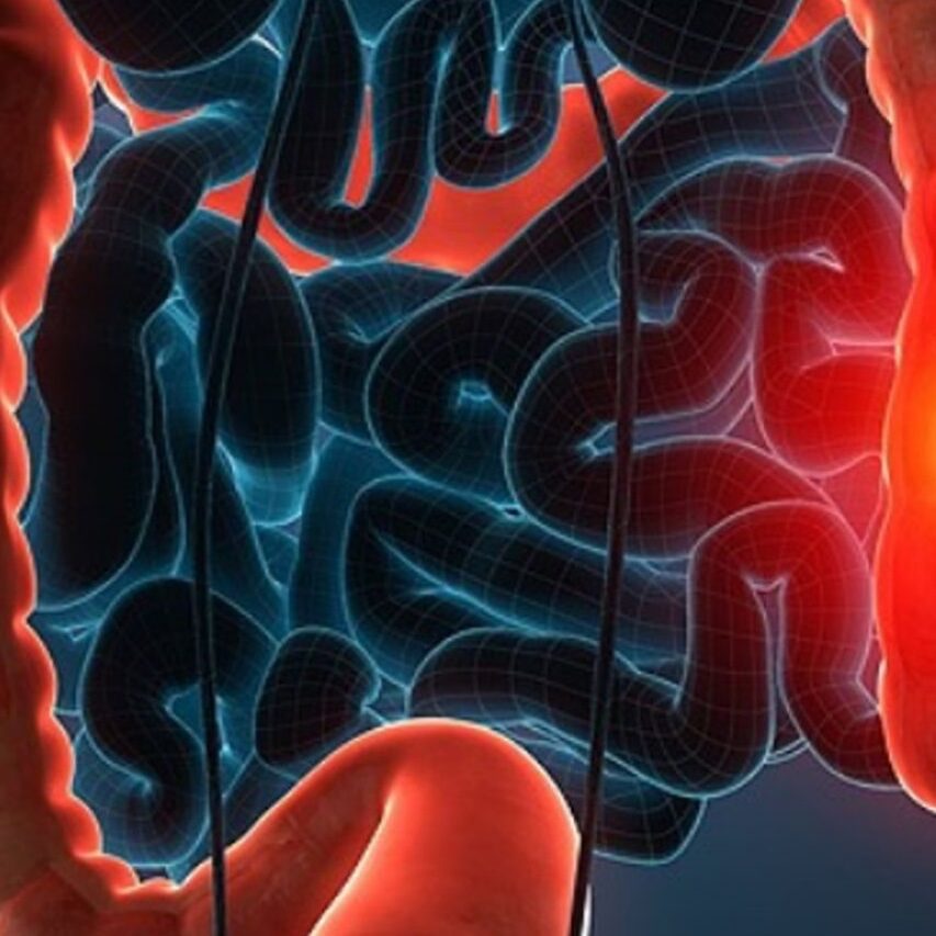 Βιοψία του ορθού