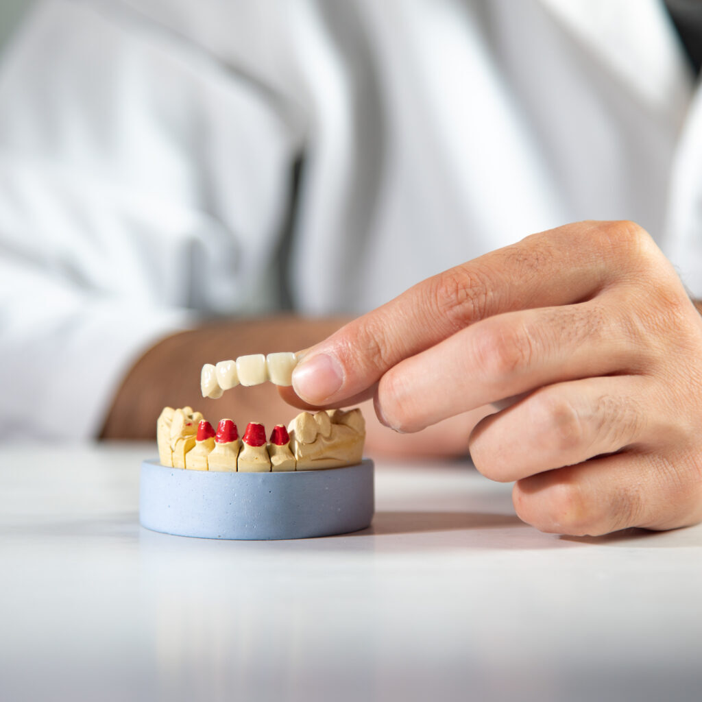 Γέφυρες δοντιών και εμφυτεύματα