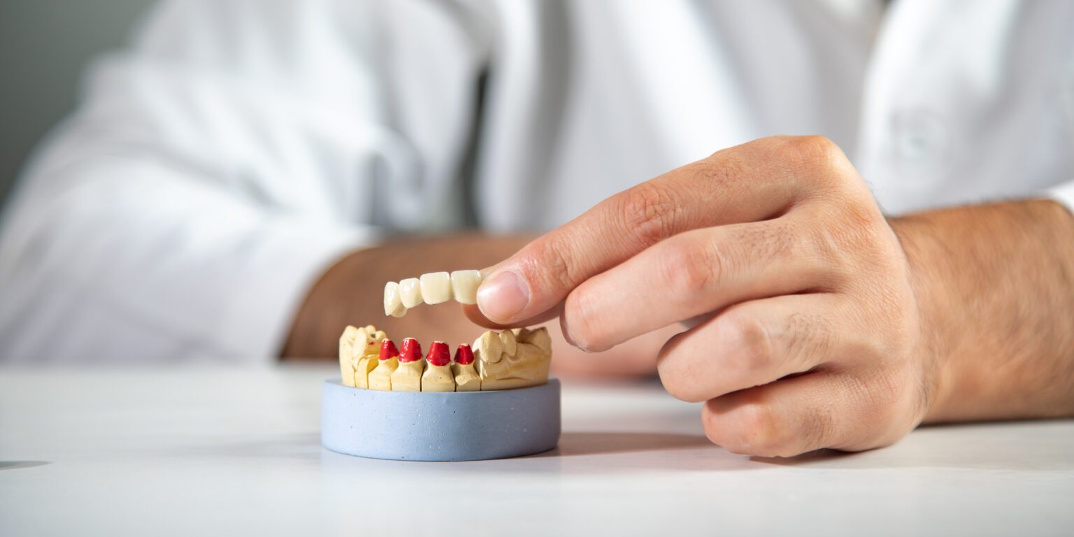 Γέφυρες δοντιών και εμφυτεύματα