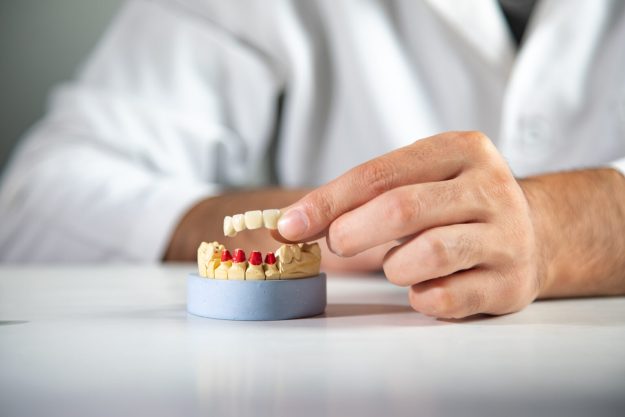 Γέφυρες δοντιών και εμφυτεύματα