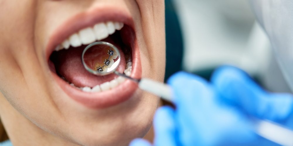 Γλωσσικά σιδεράκια & Πλεονεκτήματα