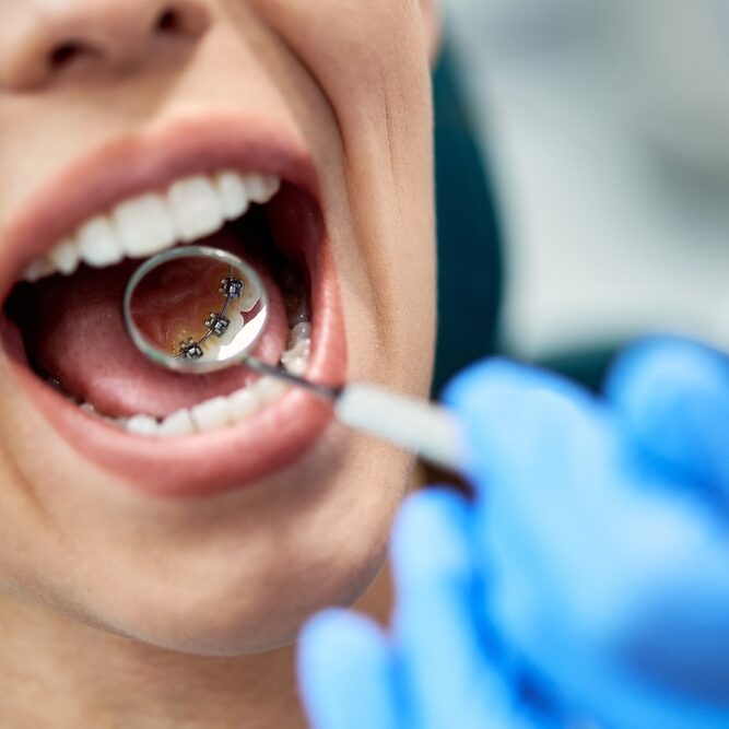 Γλωσσικά σιδεράκια & Πλεονεκτήματα